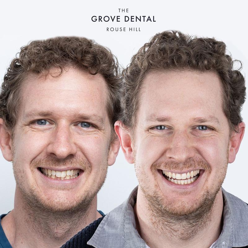 Sam — Clear Aligners